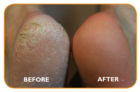 Silky Feet Callus Remover™