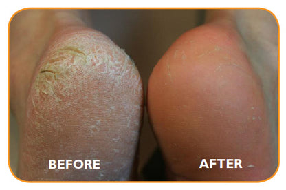 Silky Feet Callus Remover™